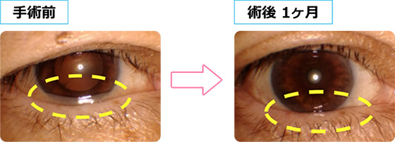 眼手術学　4 角膜・結膜・眼瞼手術 眼手術学 4 角膜・結膜・屈折矯正 - 眼科専門書店 オー・ビー