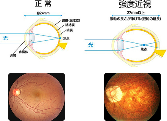 人気 眼軸長 調節ラグ 鳥居 大人 近視