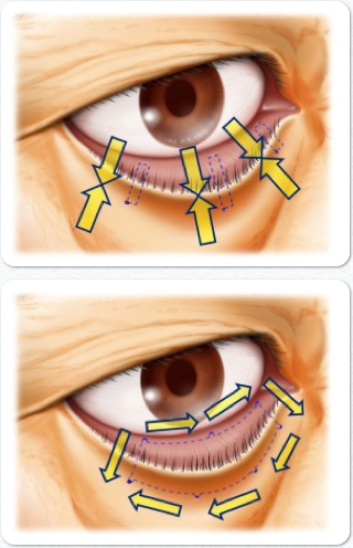 眼瞼内反症の治療法