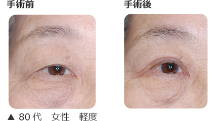眼瞼下垂手術の術式と手術例 | 横浜桜木町眼科【日ノ出町駅 桜木町駅